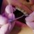 Orthodontic Treatment